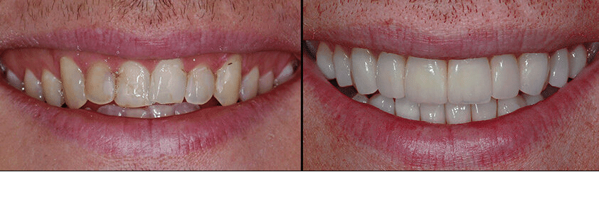 imagen de caso real de carillas lanchares dental 2